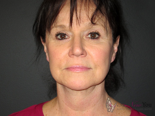 Female Facelift After Female Facelift After - Chicago, IL