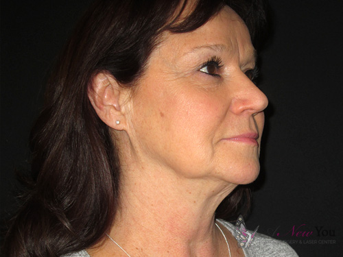 Female Facelift Before Female Facelift Before - Chicago, IL
