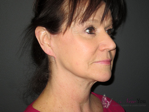Female Facelift After Female Facelift After - Chicago, IL