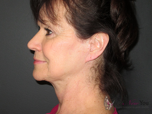 Female Facelift After - Chicago, IL