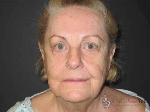 Female Facelift Before - Chicago, IL