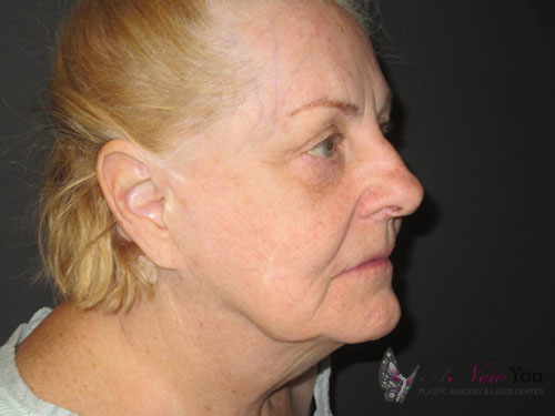 Female Facelift Before - Chicago, IL