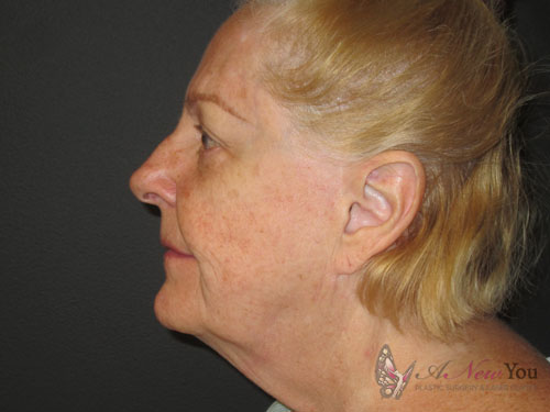 Female Facelift Before - Chicago, IL