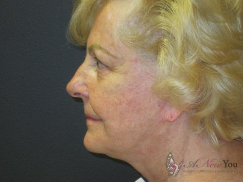 Female Facelift After - Chicago, IL