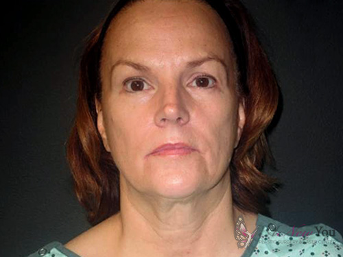 Female Facelift Before - Chicago, IL