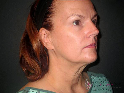 Female Facelift Before - Chicago, IL