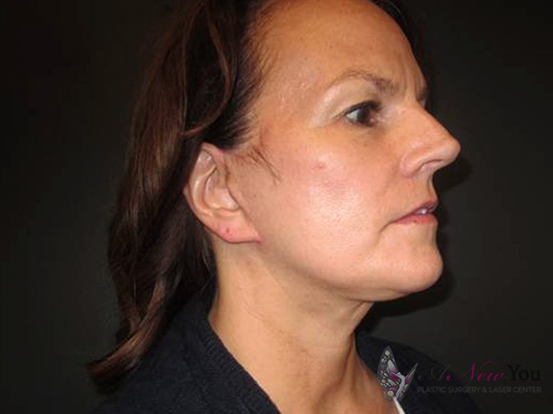 Female Facelift After - Chicago, IL