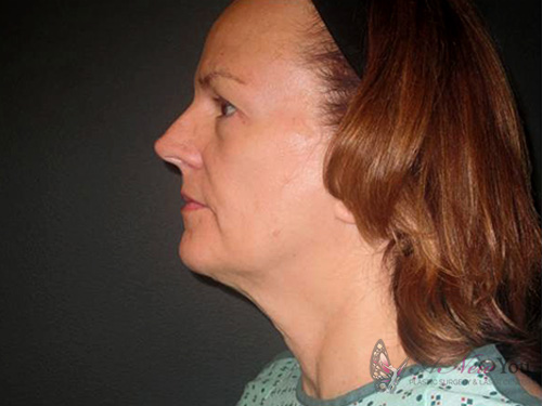 Female Facelift Before - Chicago, IL