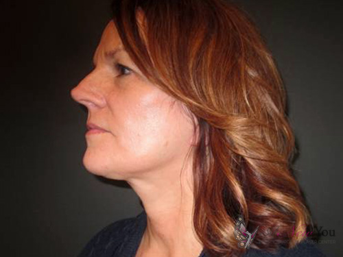 Female Facelift After Female Facelift After - Chicago, IL