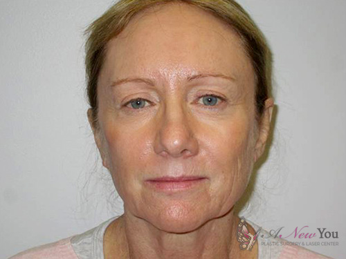 Female Facelift Before - Chicago, IL