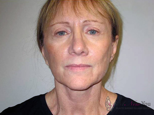 Female Facelift After - Chicago, IL