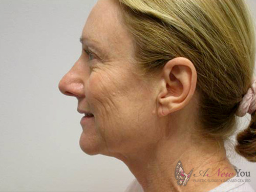 Female Facelift Before - Chicago, IL