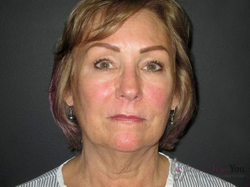 Female Facelift Before Female Facelift Before - Chicago, IL