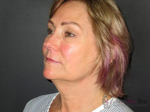 Female Facelift Before Female Facelift Before - Chicago, IL