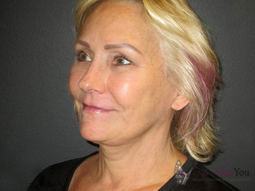 Female Facelift After Female Facelift After - Chicago, IL