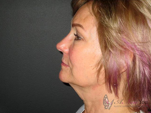 Female Facelift Before - Chicago, IL