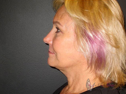 Female Facelift After - Chicago, IL