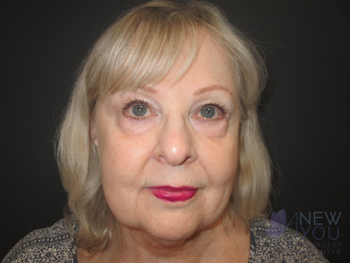 Female Facelift Before Female Facelift Before - Chicago, IL
