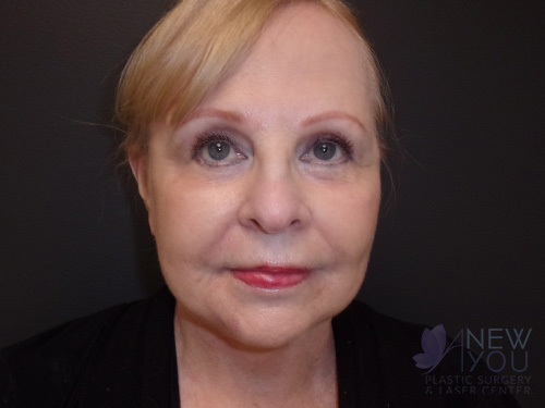 Female Facelift After Female Facelift After - Chicago, IL