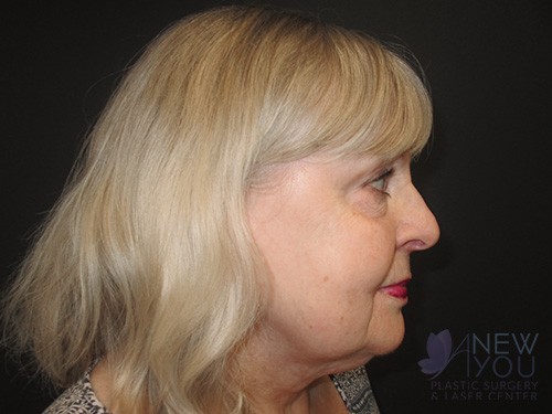 Female Facelift Before Female Facelift Before - Chicago, IL