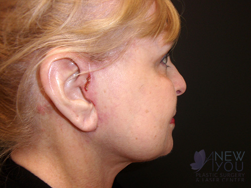 Female Facelift After Female Facelift After - Chicago, IL