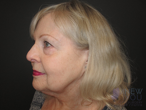 Female Facelift Before Female Facelift Before - Chicago, IL
