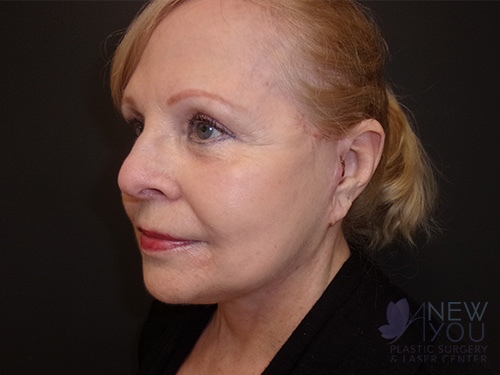 Female Facelift After Female Facelift After - Chicago, IL
