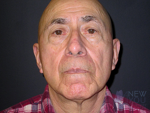 Male Facelift Before Male Facelift Before - Chicago, IL