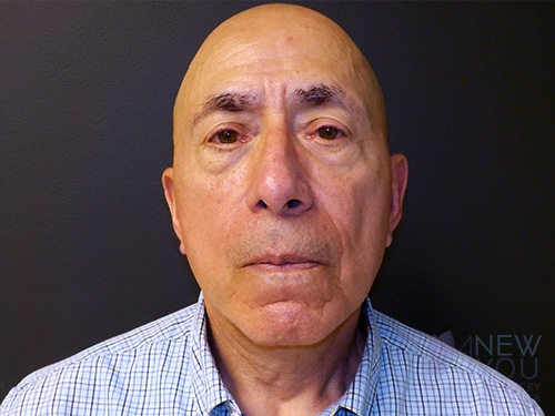 Male Facelift After Male Facelift After - Chicago, IL