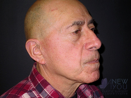 Male Facelift Before Male Facelift Before - Chicago, IL