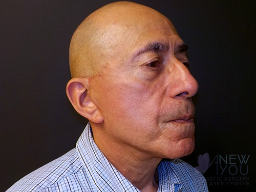 Male Facelift After - Chicago, IL