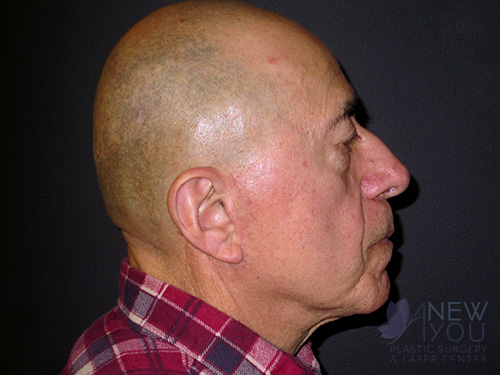 Male Facelift Before - Chicago, IL