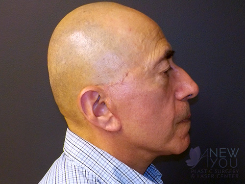 Male Facelift After - Chicago, IL