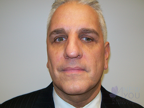 Male Facelift After - Chicago, IL