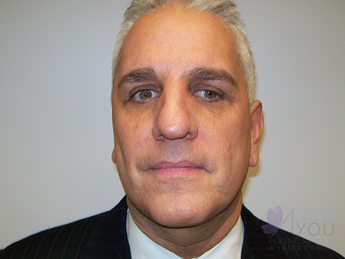 Male Facelift After Male Facelift After - Chicago, IL