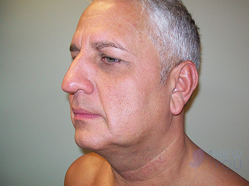 Male Facelift Before - Chicago, IL
