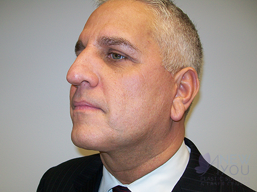 Male Facelift After Male Facelift After - Chicago, IL