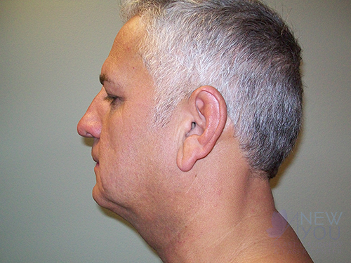 Male Facelift Before - Chicago, IL