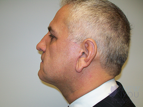 Male Facelift After Male Facelift After - Chicago, IL