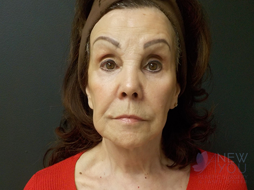 Female Facelift Before - Chicago, IL