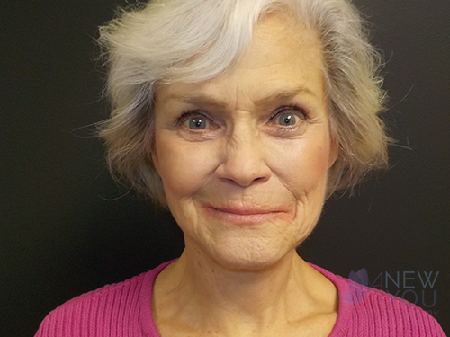 Female Facelift After Female Facelift After - Chicago, IL