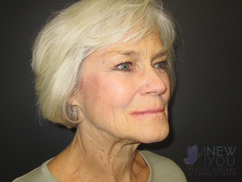 Female Facelift Before Female Facelift Before - Chicago, IL