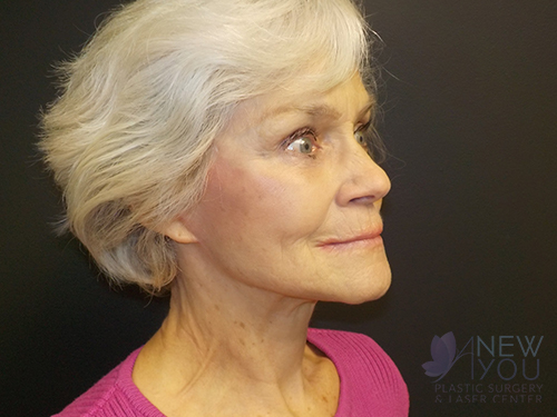 Female Facelift After Female Facelift After - Chicago, IL