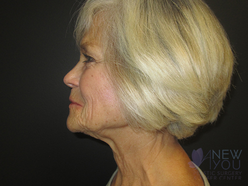 Female Facelift Before Female Facelift Before - Chicago, IL