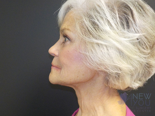 Female Facelift After Female Facelift After - Chicago, IL
