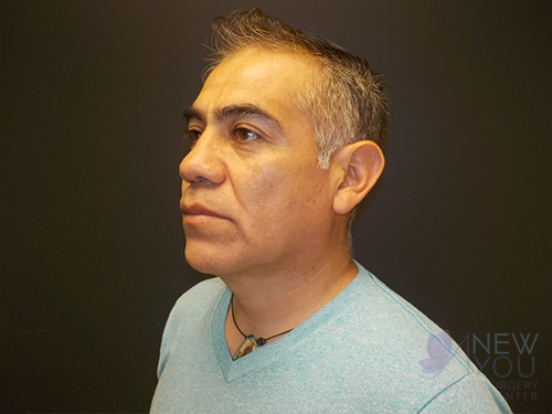 Female Facelift Before Female Facelift Before - Chicago, IL
