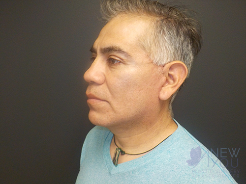 Female Facelift After Female Facelift After - Chicago, IL