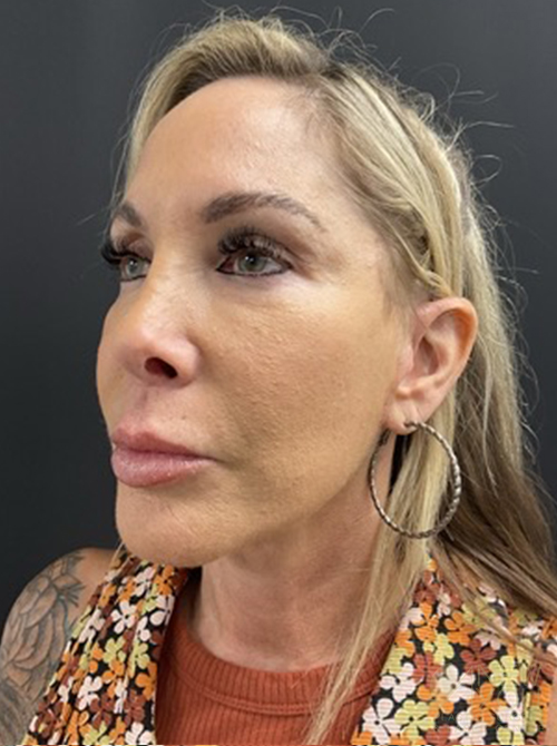 Facelift After Facelift After - Chicago, IL