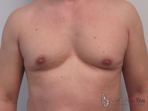 Gynecomastia Before - Chicago, IL