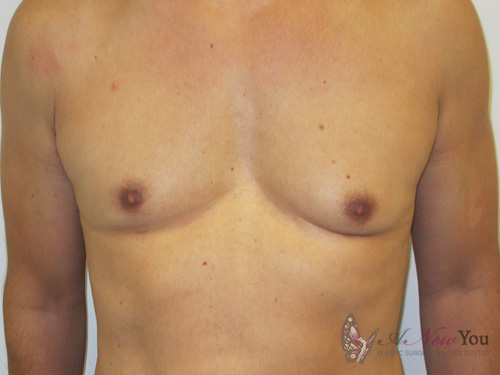 Gynecomastia After - Chicago, IL